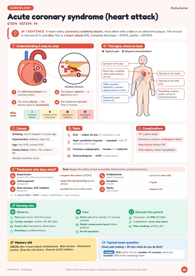Acute coronary syndrome (ACS) card from PathoCards